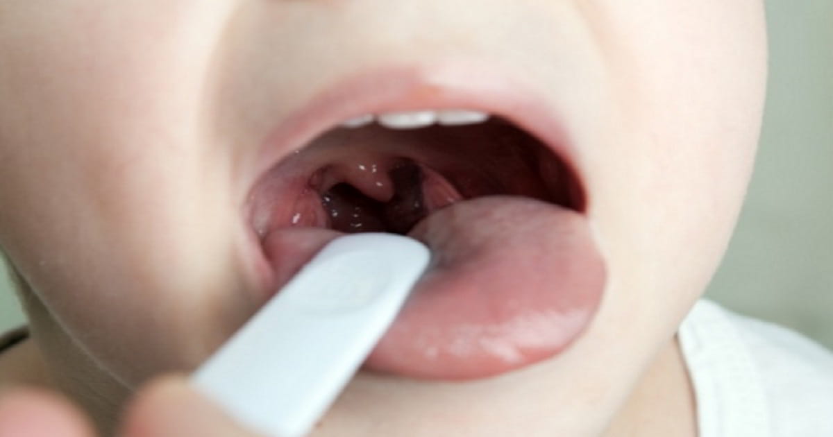 Como quitar la amigdalitis y dolor de garganta - Beliefnet
